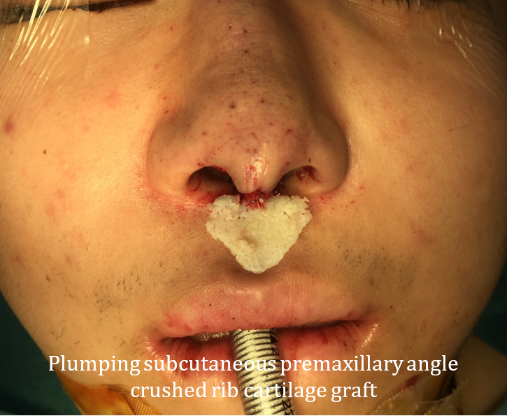 Figure 9. Crushed cartilage graft placed in subcutaneous plane to address premaxillary retrusion just inferior to the nasal base