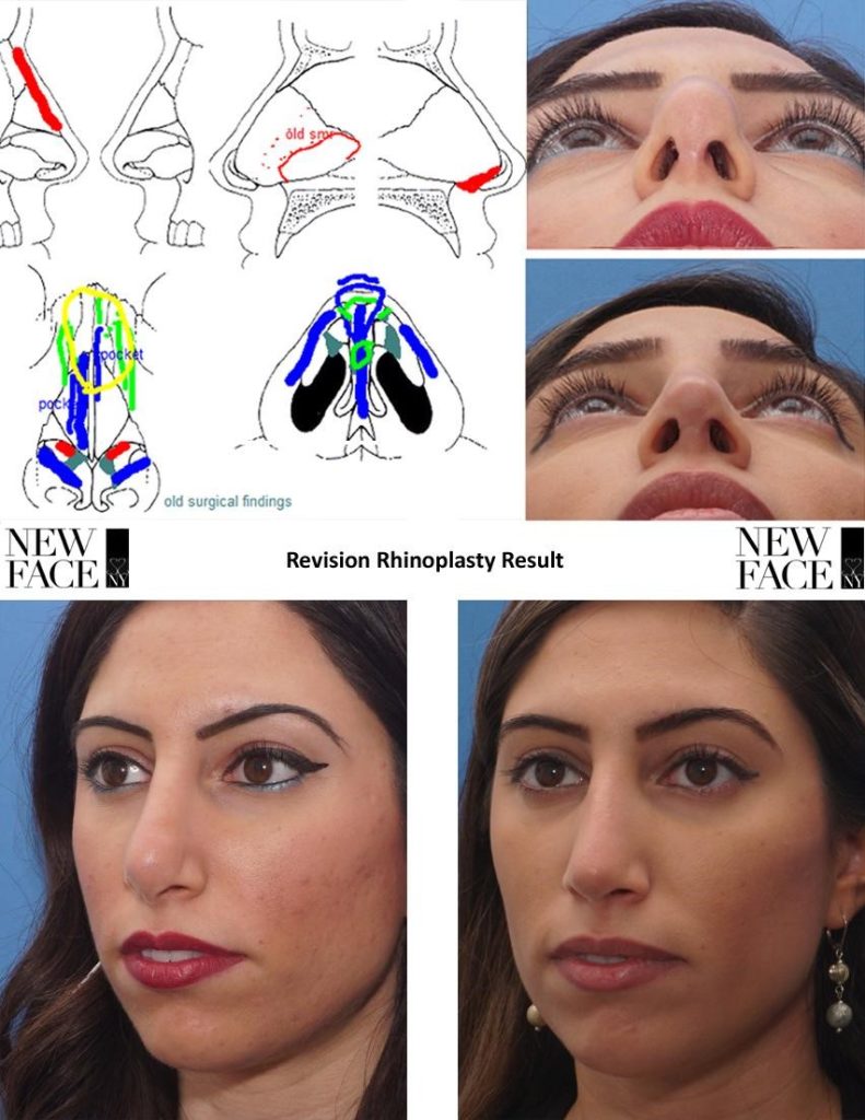 A better lip-nose contour and more refined nasal tip were achieved during  this nose job