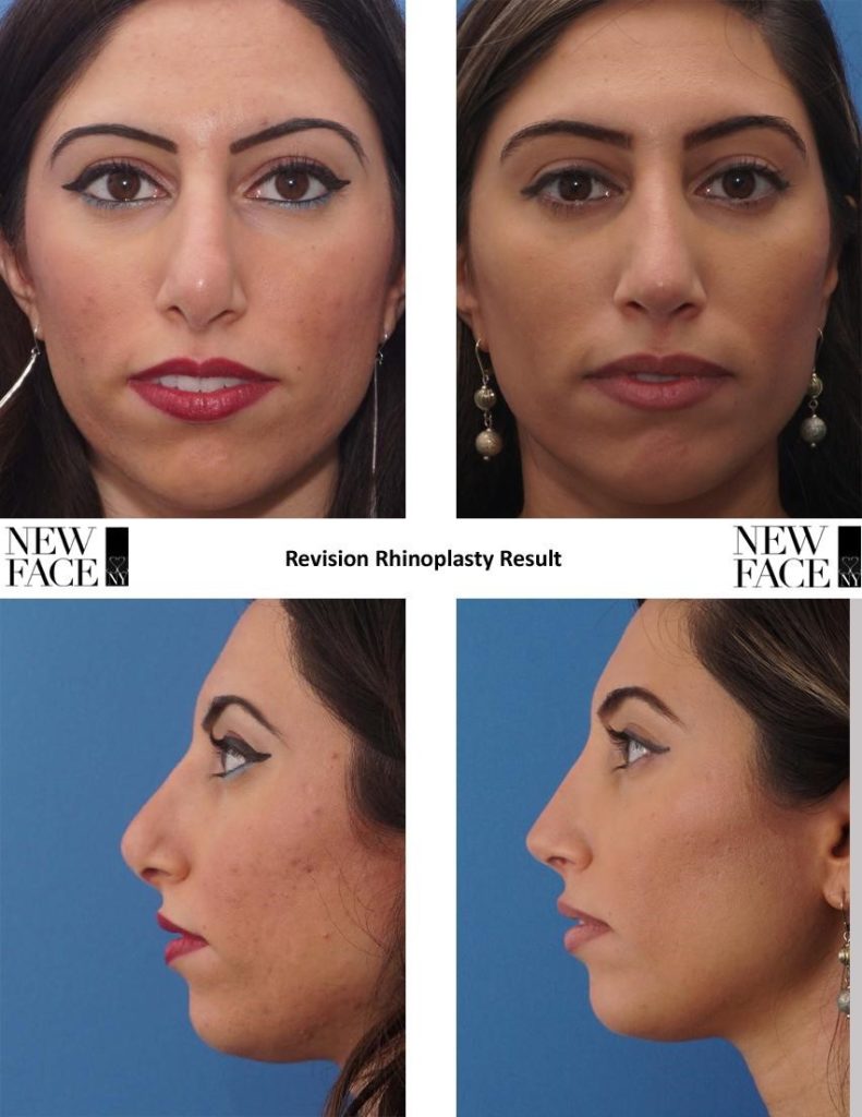 Figure: Revision rhinoplasty result. Despite near complete destruction of an intact strip bilaterally, the nasal tip was able to be reconfigured in a harmonius proportion with the use of stabilizing grafts and appropriately placed domes. This case demonstrated a full ITL due to closure of the domes inferiorly in the prior surgery.  Reversal of multiple cartilage divisions and opening of the closed caudal space of the dome unit were the main interventions. Columellar: tip ratio as well as infratip lobular aesthetics were corrected, as well as symmetry, providing a natural looking result that does not appear surgical

