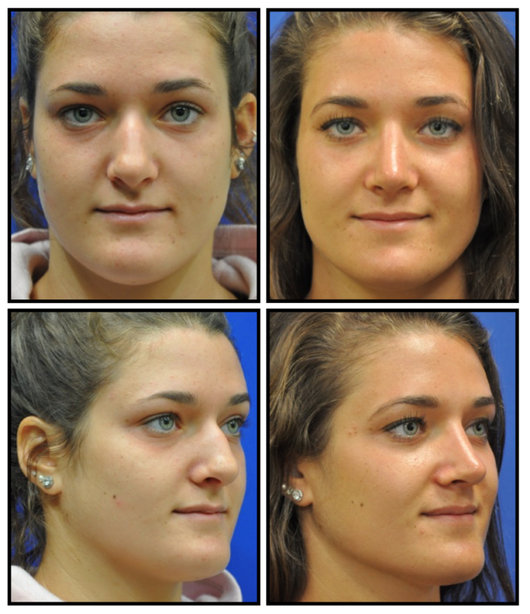 Cranial Tip Sutures for Tip Refinement Rhinoplasty Archive