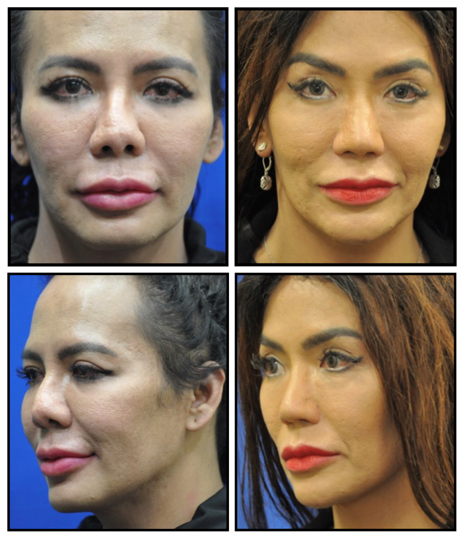 Cranial Tip Sutures for Tip Refinement Rhinoplasty Archive