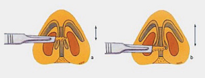 Figure 3: Partial Transfixion (Left) and Full transfixion (right) incisions. A
complete transfixion incision interrupts both mucosal surfaces and medial
crural attachments, allowing the tip to settle closer to the face. It is often one of the simplest mechanisms to achieve subtle tip deprojection. (Figure from
Trenite et al, with permission).