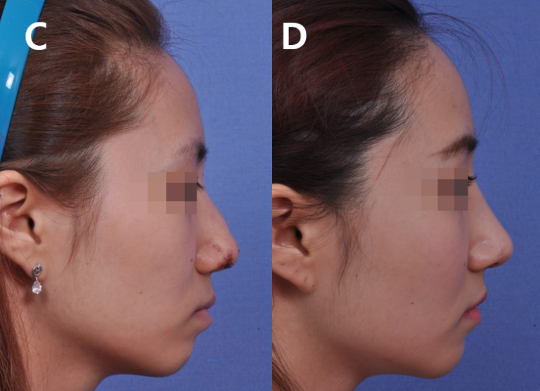 Symptoms and treatment of necrosis of the nose after filler injection
