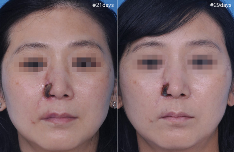 Symptoms and treatment of necrosis of the nose after filler injection