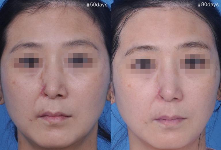 Symptoms and treatment of necrosis of the nose after filler injection