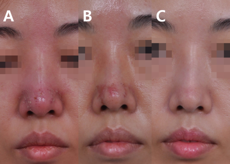 Symptoms and treatment of necrosis of the nose after filler injection