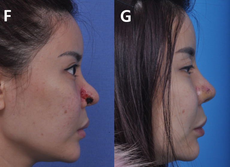 Symptoms and treatment of necrosis of the nose after filler injection
