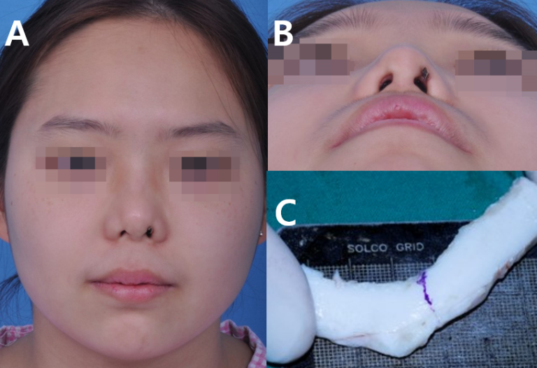 Symptoms and treatment of necrosis of the nose after filler injection