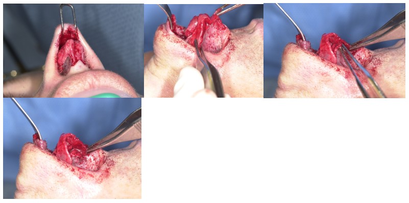 Figure 3
Intraoperative photo depicting freed vestibular skin from the undersurface of the entire LLC.