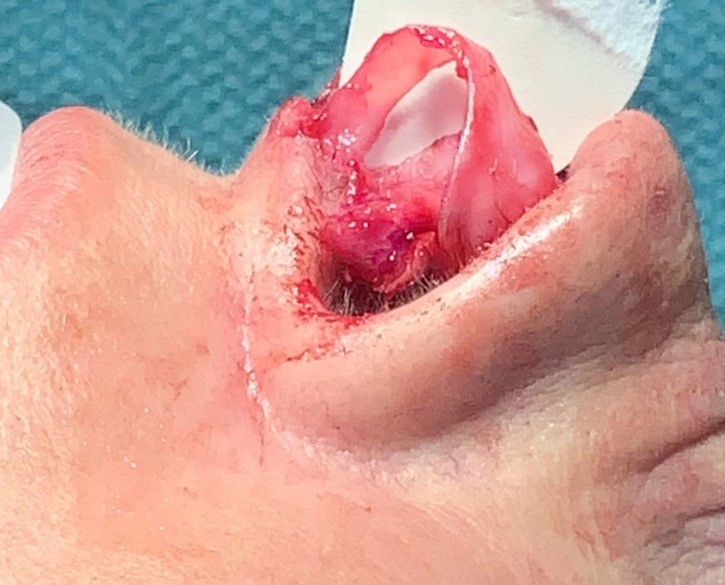 Figure 4a
Intraoperative photo demonstrating the relationship of the medial crus to the caudal septum