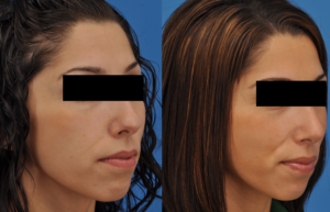 Figure 1: Pre-operative and 6-month post-operative photos for a patient who underwent an endonasal septorhinoplasty with spreader graft placement and dorsal hump reduction. Improvement in her pre-operative middle vault hourglass shape.