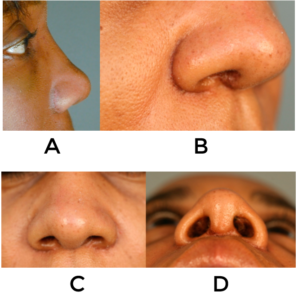 African American Rhinoplasty - Rhinoplasty Archive