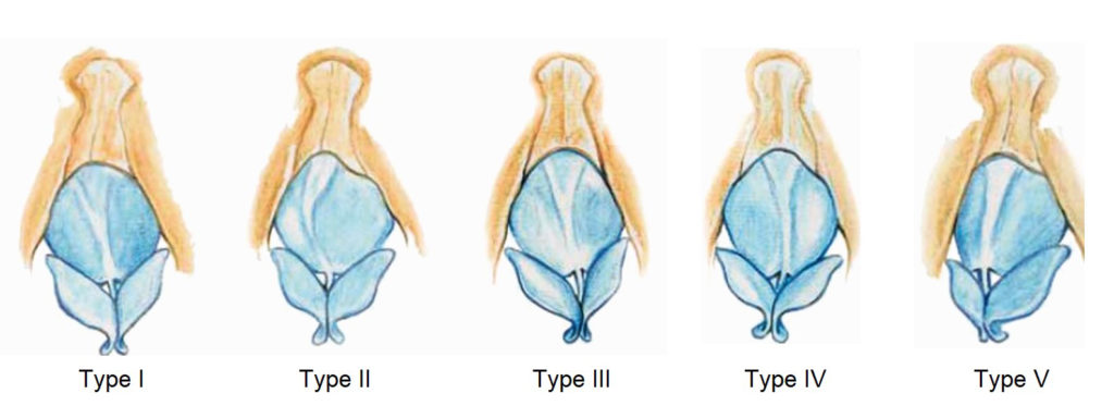 Figure 1. Depending on the orientation of the bony pyramid and the cartilaginous vault, the deviation noses are classified into five types.