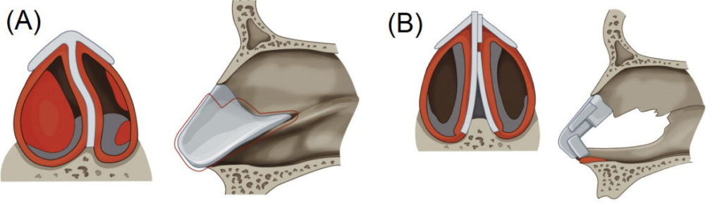 Figure 10. (A) Septal cartilage is removed except the remaining few millimeters of the dorsal strip at the keystone area. (B) Newly formed straight and strong L-strut, which is made extracorporeally is reconnected to the cartilage tail at the keystone area and soft tissue around the anterior nasal spine.