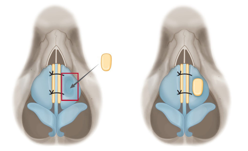 Figure 11. With placing spreader grafts and straightening the septum, upper lateral cartilage deviation can be corrected. Remaining concavity can be corrected by placing an onlay graft.