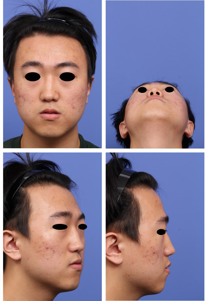 Figure 2. Facial photographs from frontal, basal, oblique, and profile views should be obtained to evaluate the deviated nose of the patient properly.