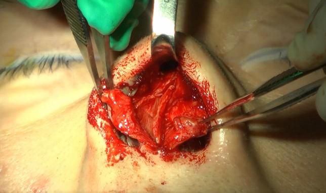 Figure 3. Through an open rhinoplasty approach, all anatomic structures including deviated dorsal septum can be clearly identified.