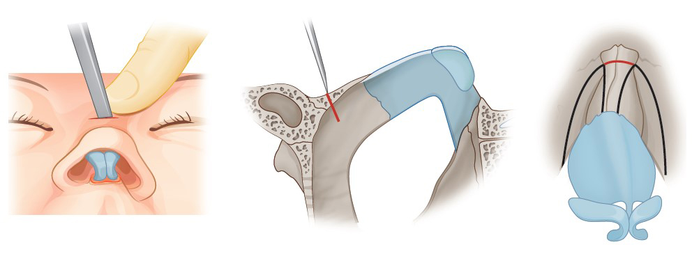 Figure 4. Percutaneous root osteotomy can be performed to make a controlled fracture at the midline bony segment remaining after medial and lateral osteotomies.