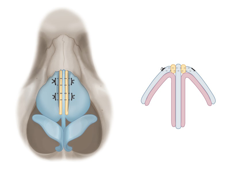 Figure 5. Spreader grafts placed on the both sides of dorsal septum. The fixation between the spreader graft and the dorsal strut of the septum is done using 5-0 or 4-0 PDS, and the fixation between the upper lateral cartilage and the spreader graft-septal cartilage complex is done using 4-0 PDS.