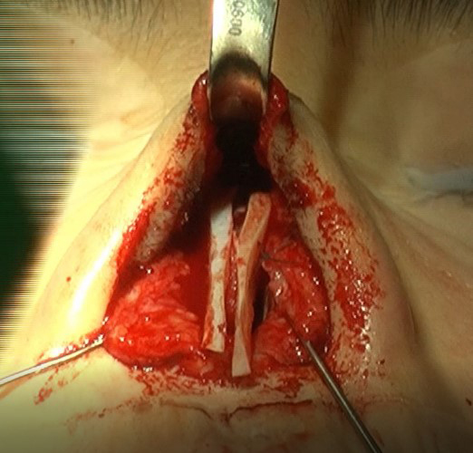 Figure 6. Intraoperative view of bilateral extended spreader grafts extended dorsally and caudally.