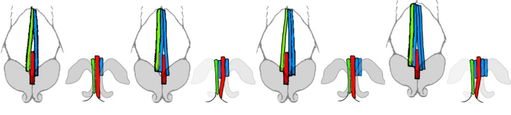 Figure 7. The illustrations of making the caudal septal extension graft (in red) into the new center, sandwiching between the native septum (in green) and the unilateral spreader graft (in blue). (A) classic type, (B) variant for bent dorsal strut, (C, D) variant for horizontal rotation. (left side: frontal view, right side: basal view)