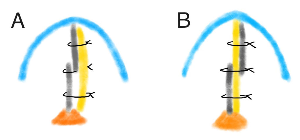 Figure 9. Illustration of conventional caudal septum cutting and suture technique with batten graft (A) and the senior author’s novel technique: caudal septal division and interposition grafting (B).