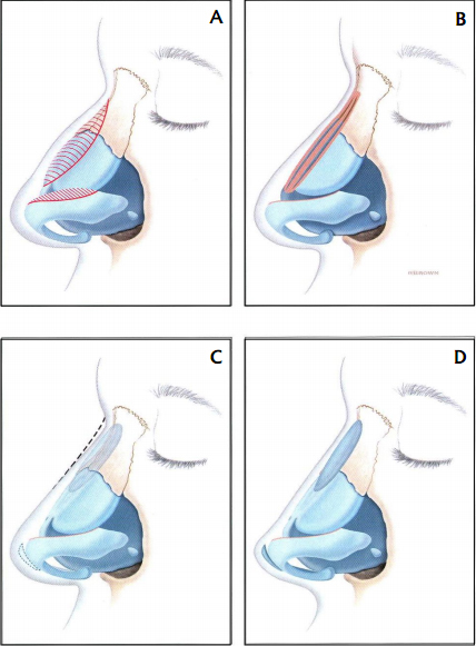 Polly Beak Deformity - Rhinoplasty Archive