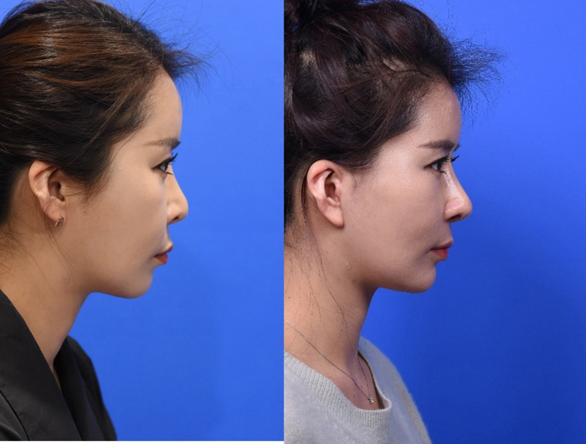 Figure 7-4. Right Lateral View - Representative case who had revision rhinoplasty and facelift. 