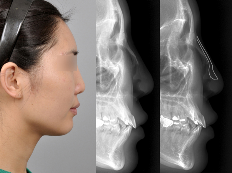 Figure 2. ePTFE implanted on nasal dorsum shows the bending deformation on X-ray