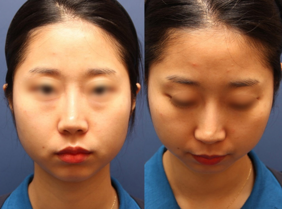 Figure 4. A female patient who had augmentation rhinoplasty with an ePTFE implant shows visible distal margins of the implant in supratip area.