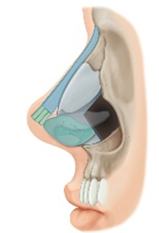 Figure 6. Dorsal augmentation with a silicone implant and tip augmentation with onlay tip grafts and septal extension graft