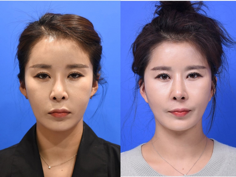 Figure 7-1. Frontal View - Representative case who had revision rhinoplasty and facelift. 