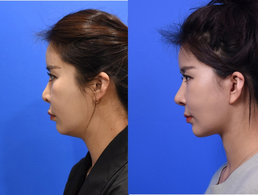 Figure 7-3. Left Lateral View - Representative case who had revision rhinoplasty and facelift. 