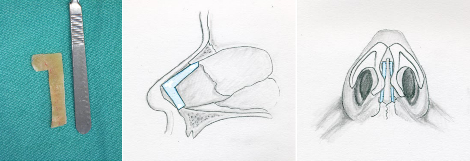 Saddle Nose Deformity Rhinoplasty Archive