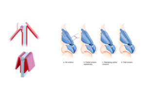 Traditional autospreader flaps. ULCs turned inwards and sutured to the nasal septum. Types of incisions made to the ULCs (Apaydin et al, 2016, Wurm & Kovacevic, 2013)