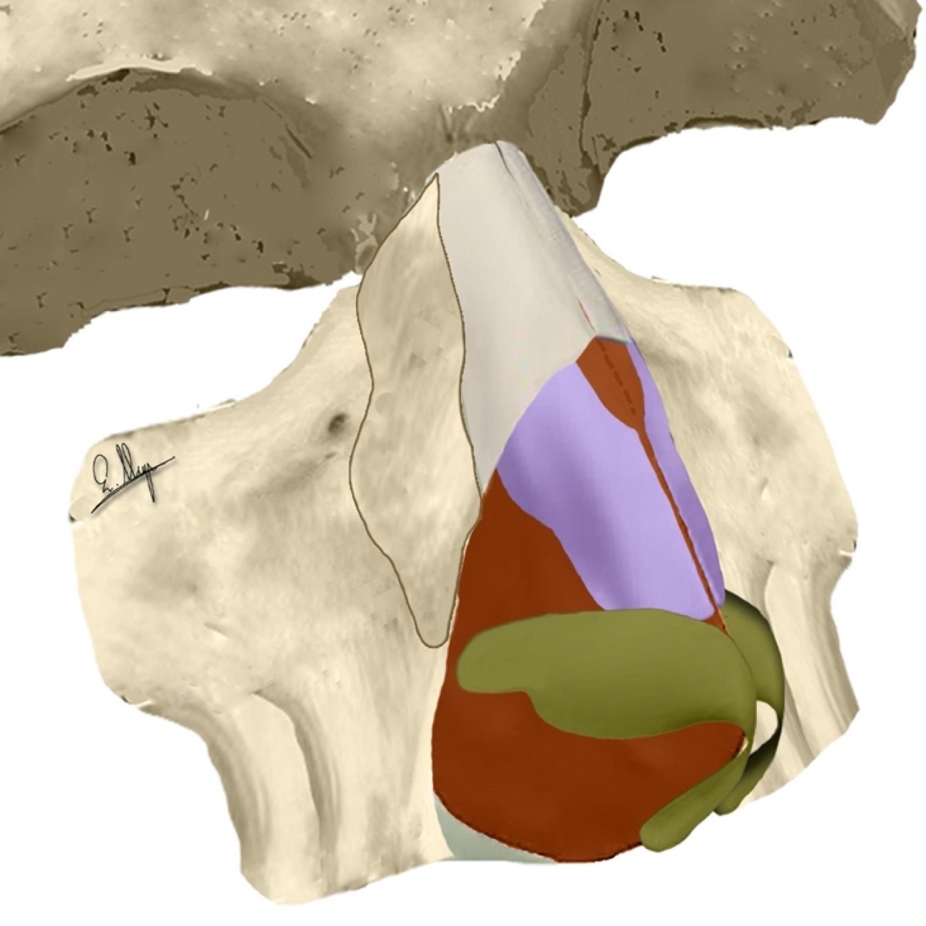 Rhinoplasty: Bony Vault Surgery with Piezoelectric Instruments