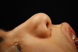 Transection of the lateral crura with resection or overlapping of the cartilage in the horizontal dimension 1