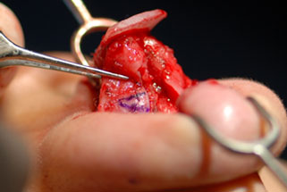 Transection of the lateral crura with resection or overlapping of the cartilage in the horizontal dimension 3