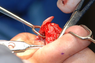 Transection of the lateral crura with resection or overlapping of the cartilage in the horizontal dimension 4