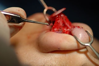 Transection of the lateral crura with resection or overlapping of the cartilage in the horizontal dimension 5