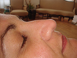 Hyaluronic acid injection 2