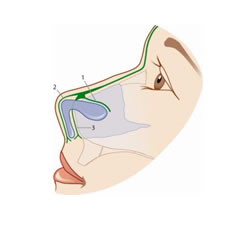 Nasal superficial musculoaponeurotic system (SMAS) with its superficial lateral layer