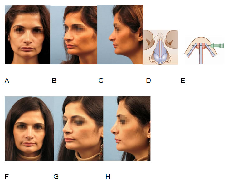 Correction of an hourglass deformity (A,B,C) with inner nasal valve stenosis