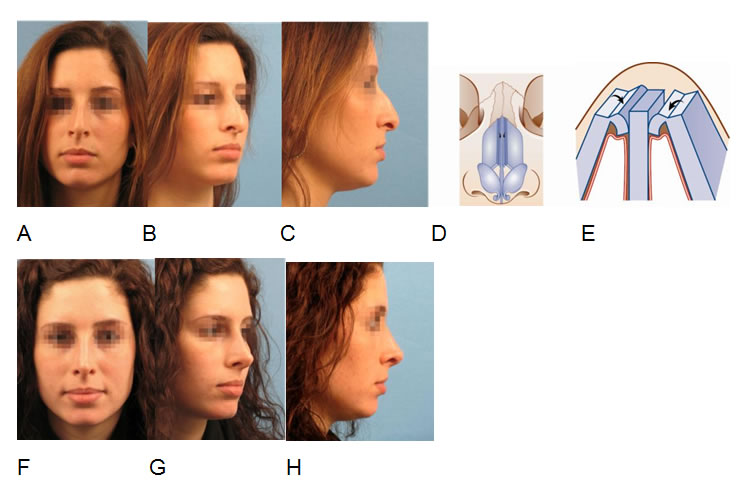 Open rhinoplasty for correction of a nasal hump and a downward rotated