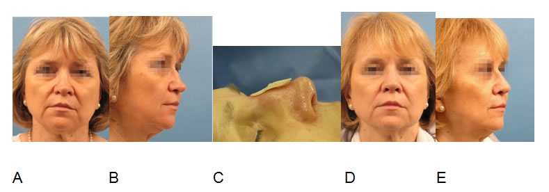 Correction of a saddle nose and inverted-V deformity (A,B) via open extracorporeal septal reconstruction