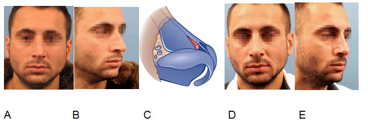 Crooked nose correction  (A,B,C) performing septoplasty and dexter unilateral spreader graft insertion