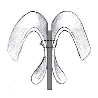 Medial Crural Fixation Suture