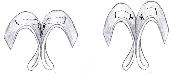 Transdomal (Dome Creating, Dome Binding, Domal Definition) Suture