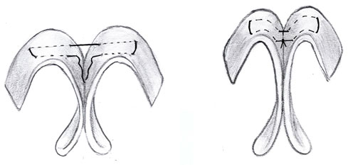 Divergence between the intermediate crura