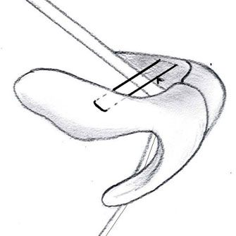 Lateral Crural Spanning Suture